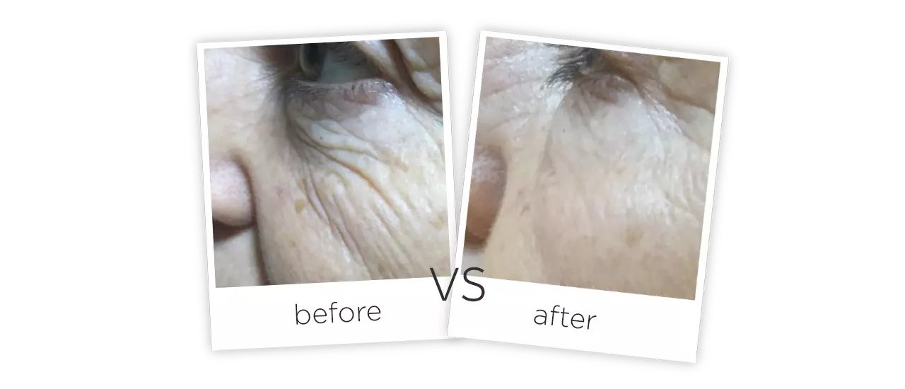RF スキンタイトニング ラジオ波 20MCOOLRF治療前＆治療後