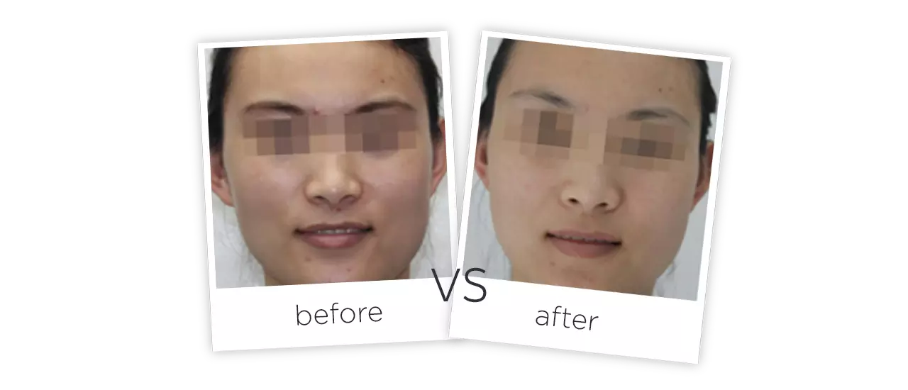 高圧エアージェットニードルレスインジェクター Treatment Before&After